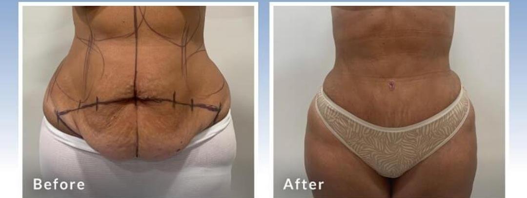 Abdominoplasty clinical or result imagery