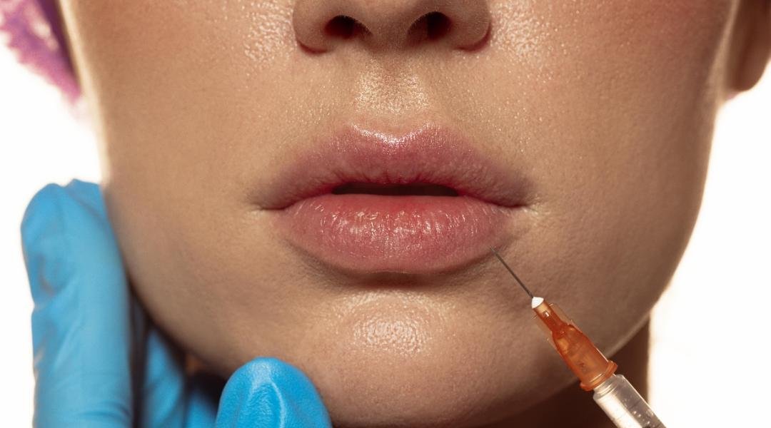 Dermal Fillers clinical or result imagery