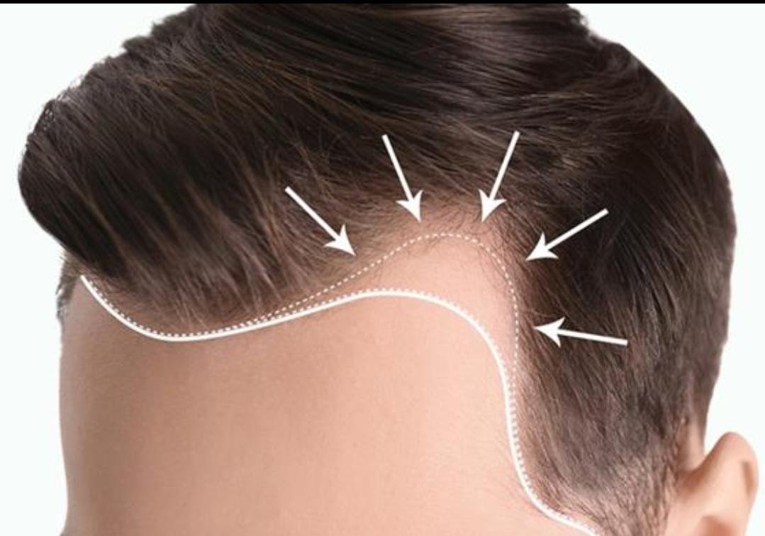 Editorial image representing hair transplantation