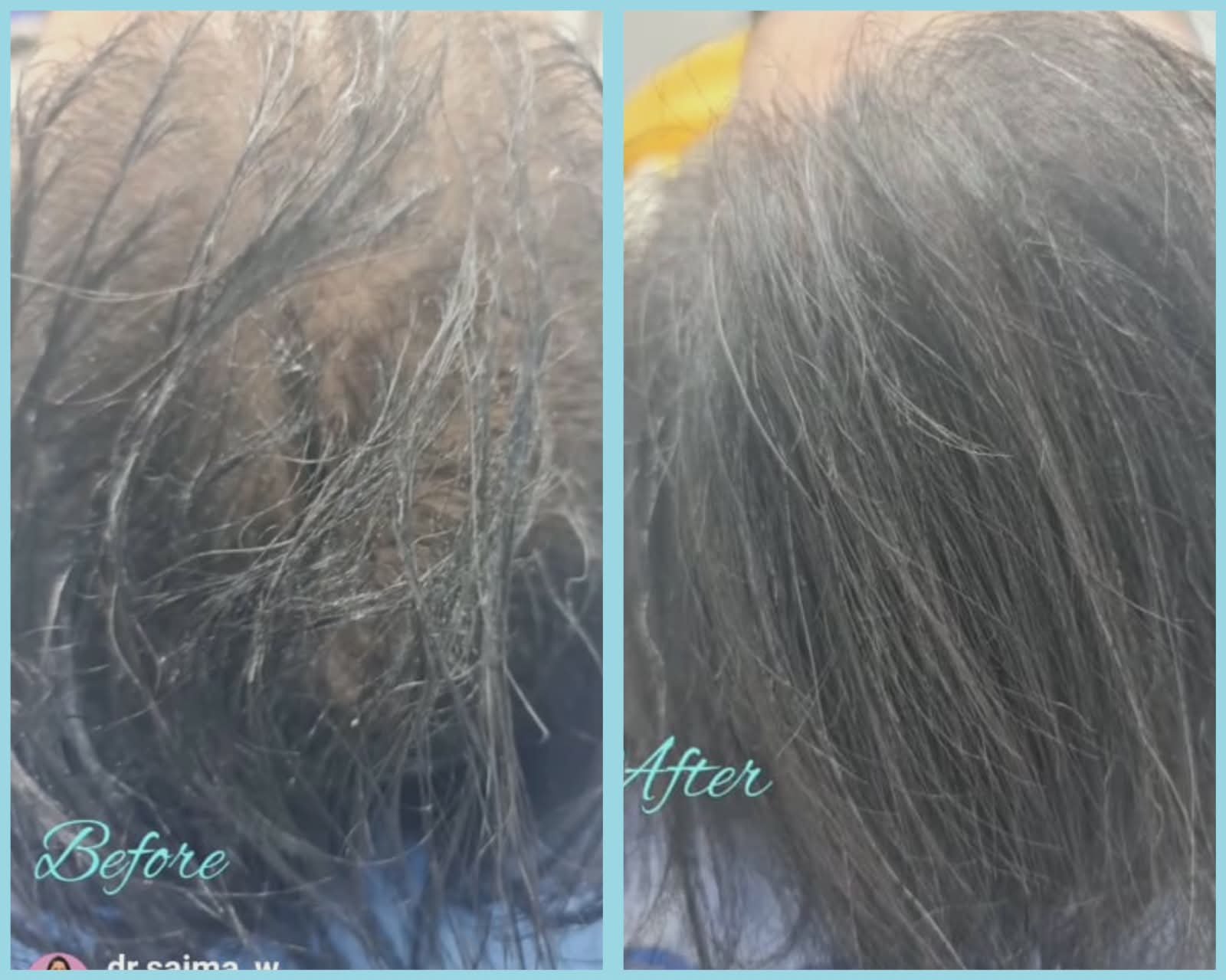 Hair Transplantation clinical or result imagery