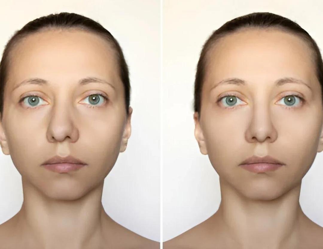 Profile view used as an editorial illustration for rhinoplasty consultation planning