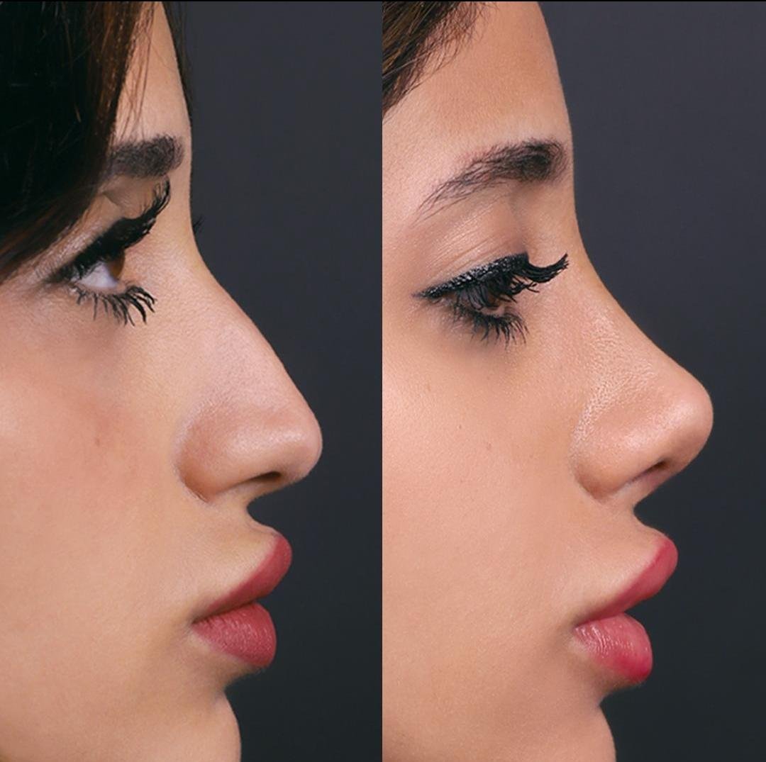 Close profile view used as an editorial illustration for nose surgery information
