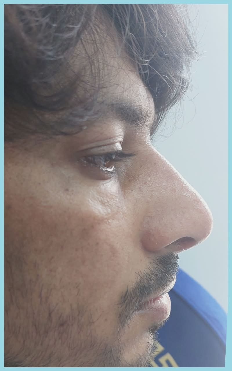Front view after rhinoplasty from the same practice transformation pair