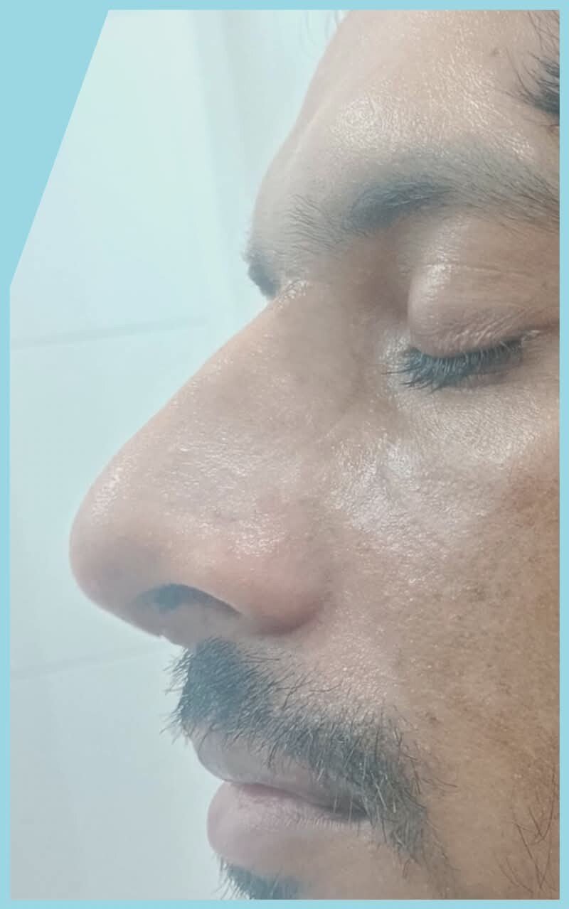 Profile after rhinoplasty from the same practice case pair