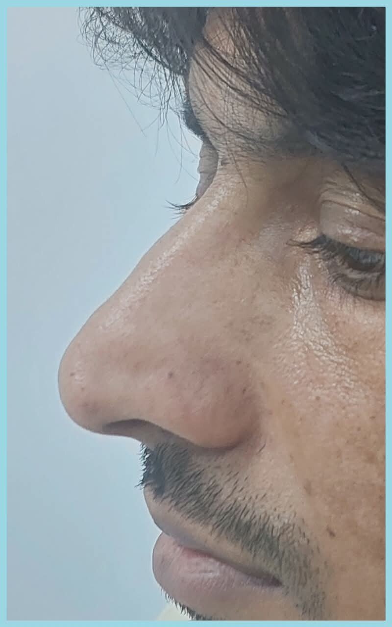 Profile before rhinoplasty from a practice case pair