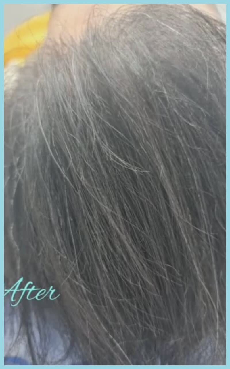 Hairline after hair transplantation from the same practice transformation pair