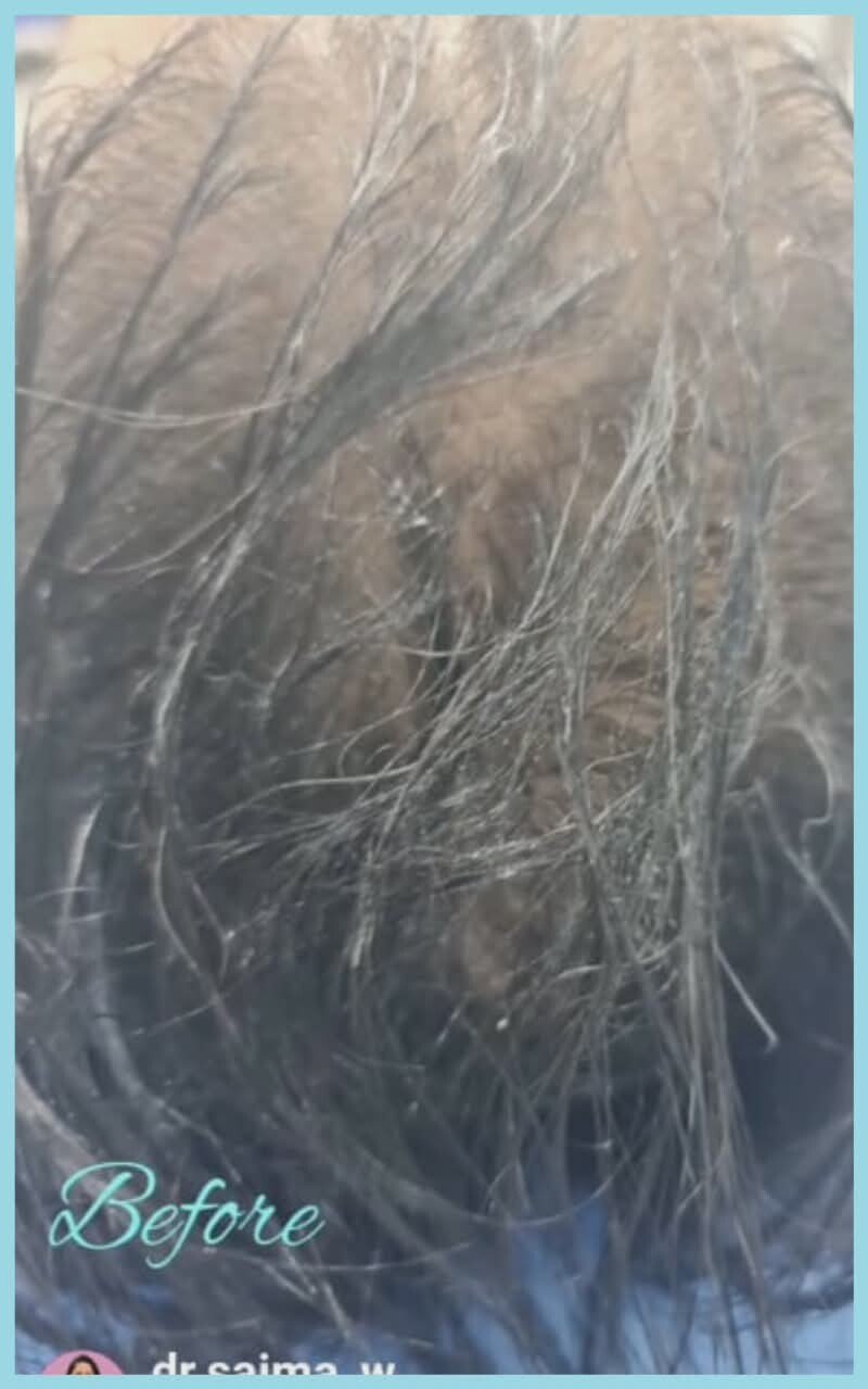 Hairline before hair transplantation from a practice transformation pair