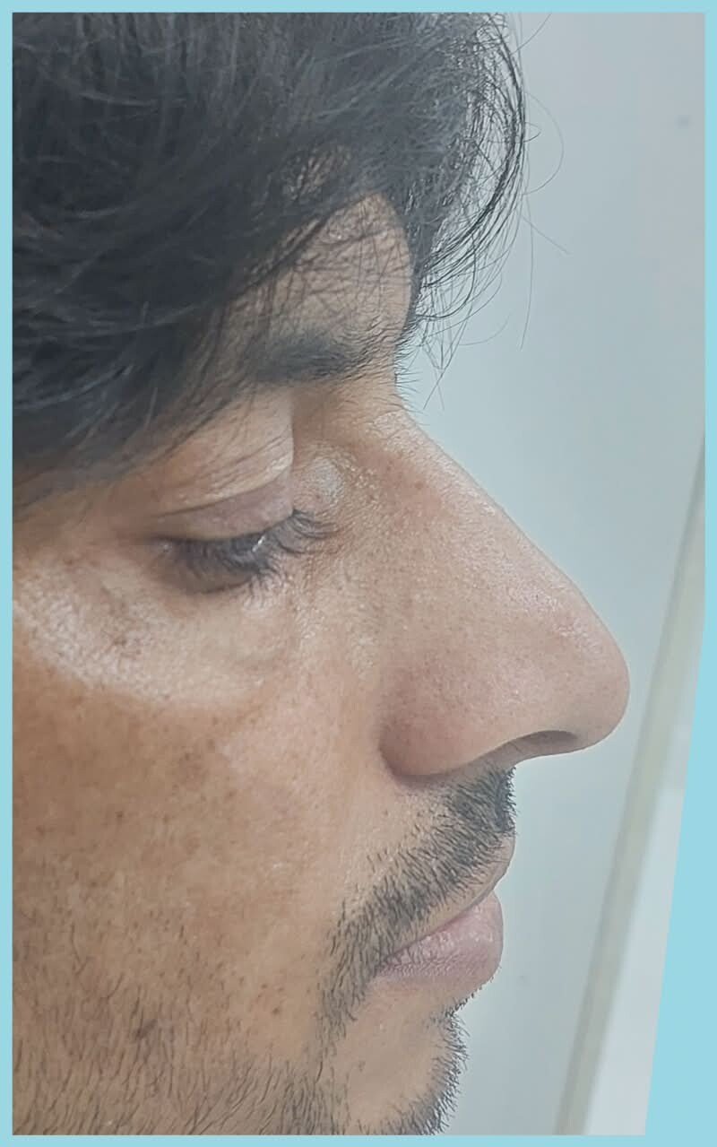 Profile view before rhinoplasty from a practice transformation pair