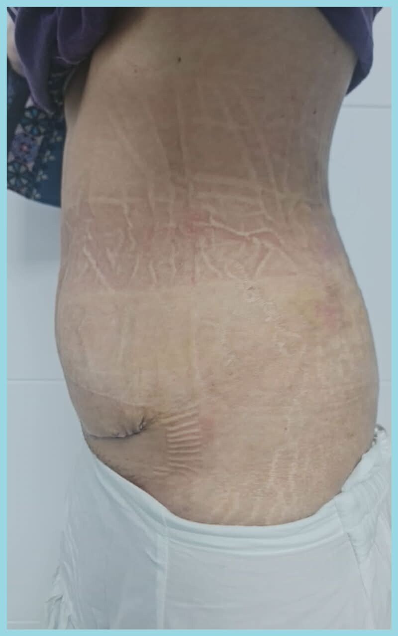 Abdominal contour after tummy tuck from the same practice transformation pair