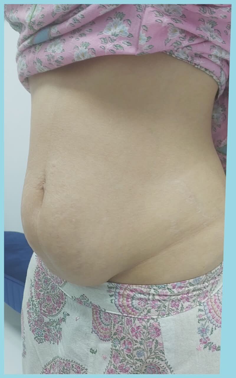 Abdominal contour before tummy tuck from a practice transformation pair