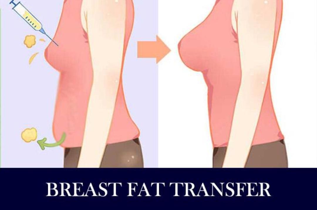 Breast augmemtation-3