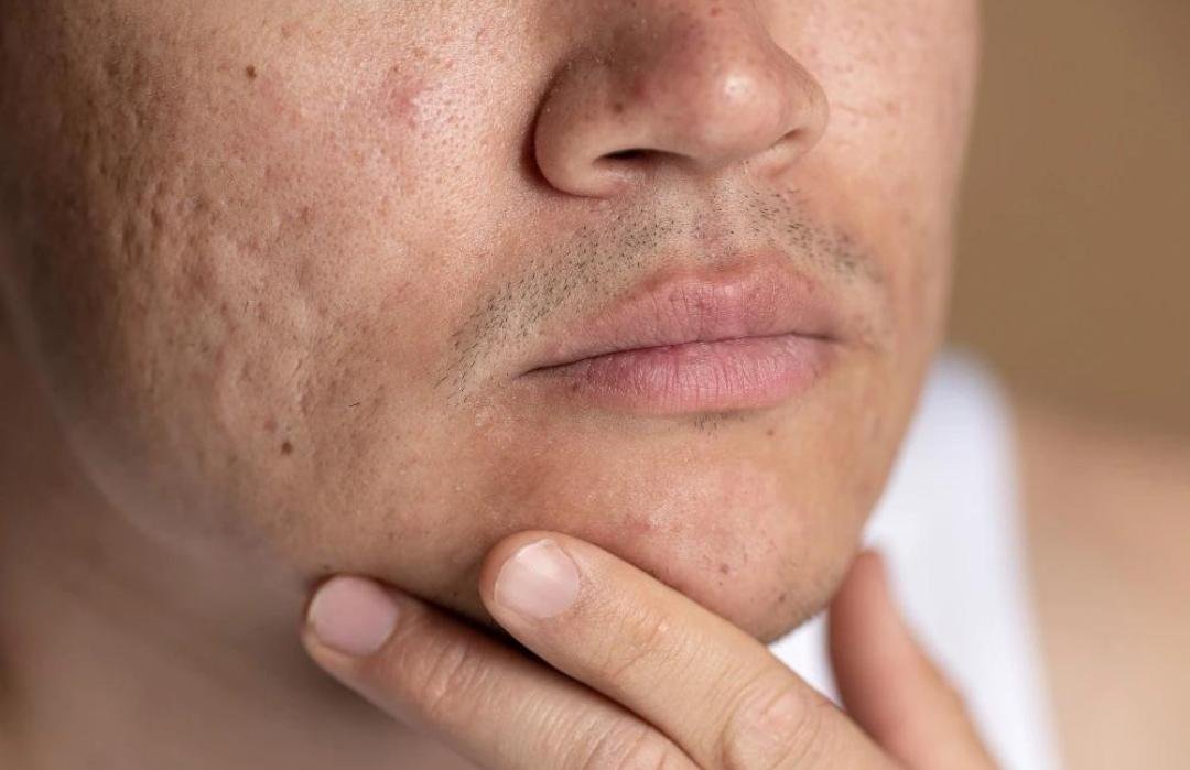 Acne Scar Treatment clinical or result imagery