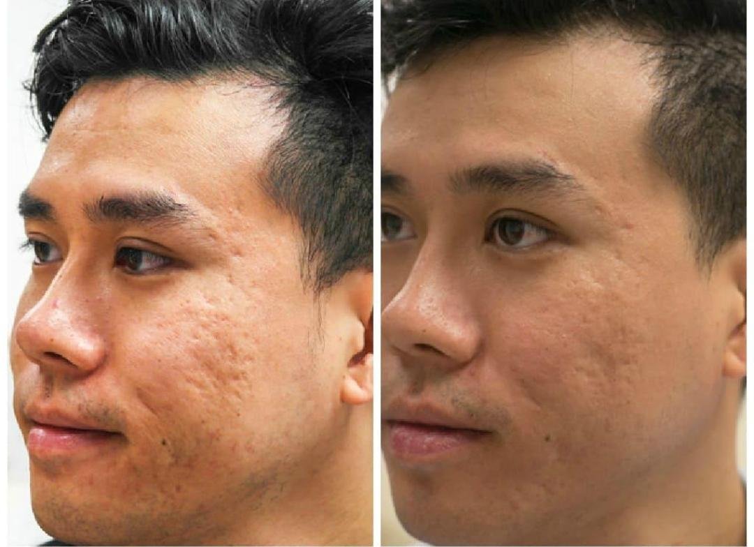 Acne Scar Treatment example from the practice media library