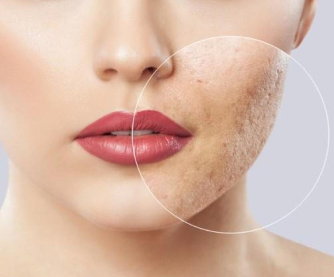 Editorial image representing acne scar treatment