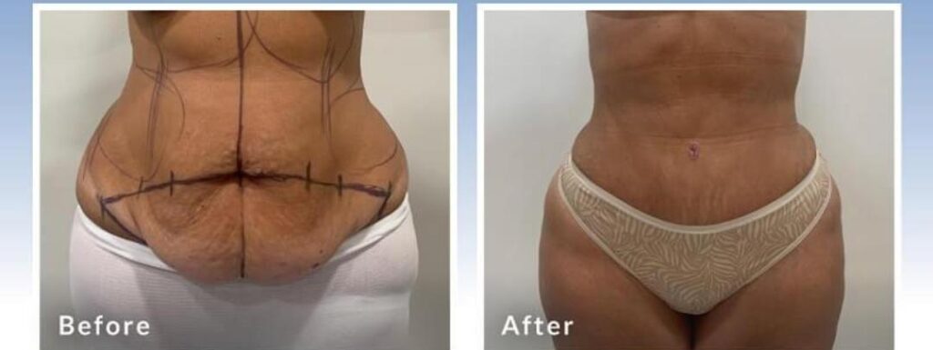 Abdominoplasty_1