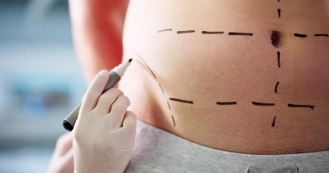 Abdominoplasty clinical or result imagery