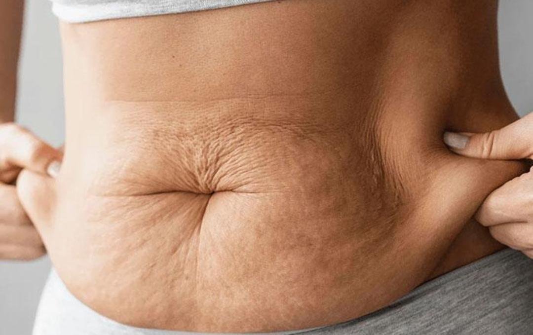 Abdominoplasty example from the practice media library