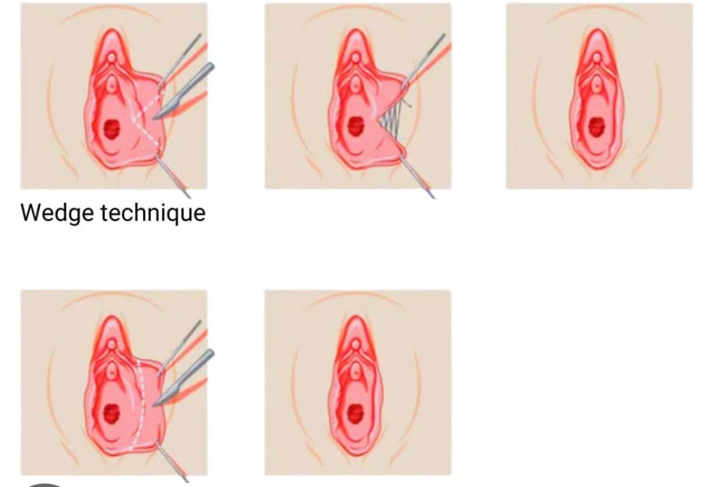 Aesthetic gynecology_2