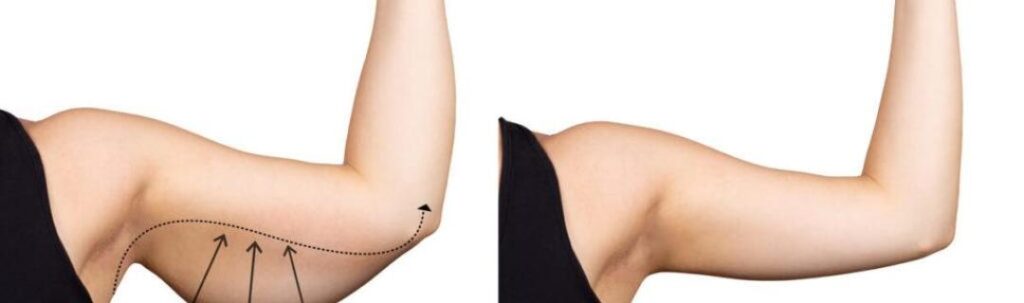 Arm lift_1