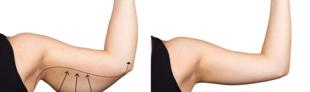 Arm Lift (Brachioplasty) clinical or result imagery