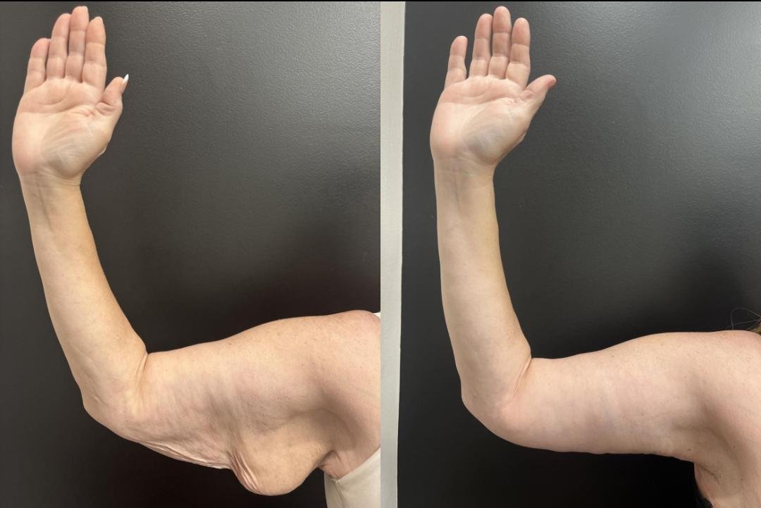 Arm Lift (Brachioplasty) clinical or result imagery