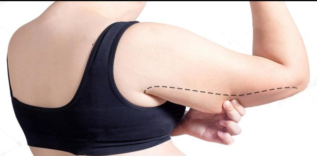 Arm Lift (Brachioplasty) example from the practice media library