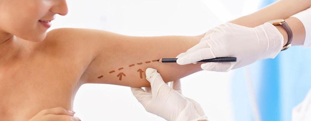 Editorial image representing arm lift (brachioplasty)