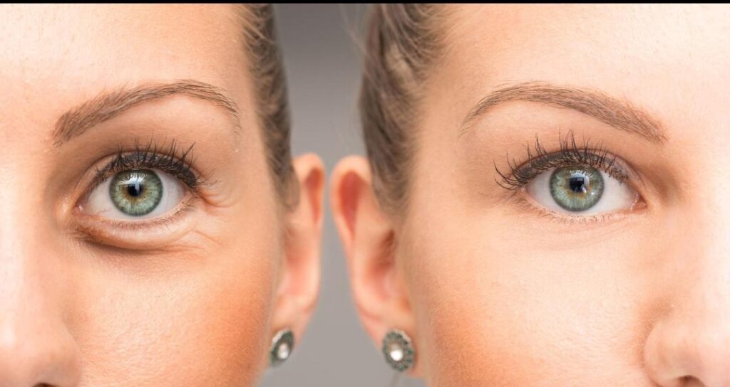 BOTOX_3