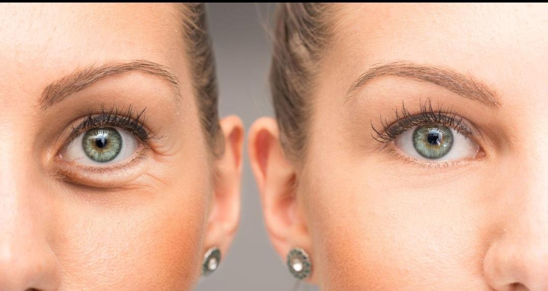 Botulinum Toxin Treatment example from the practice media library
