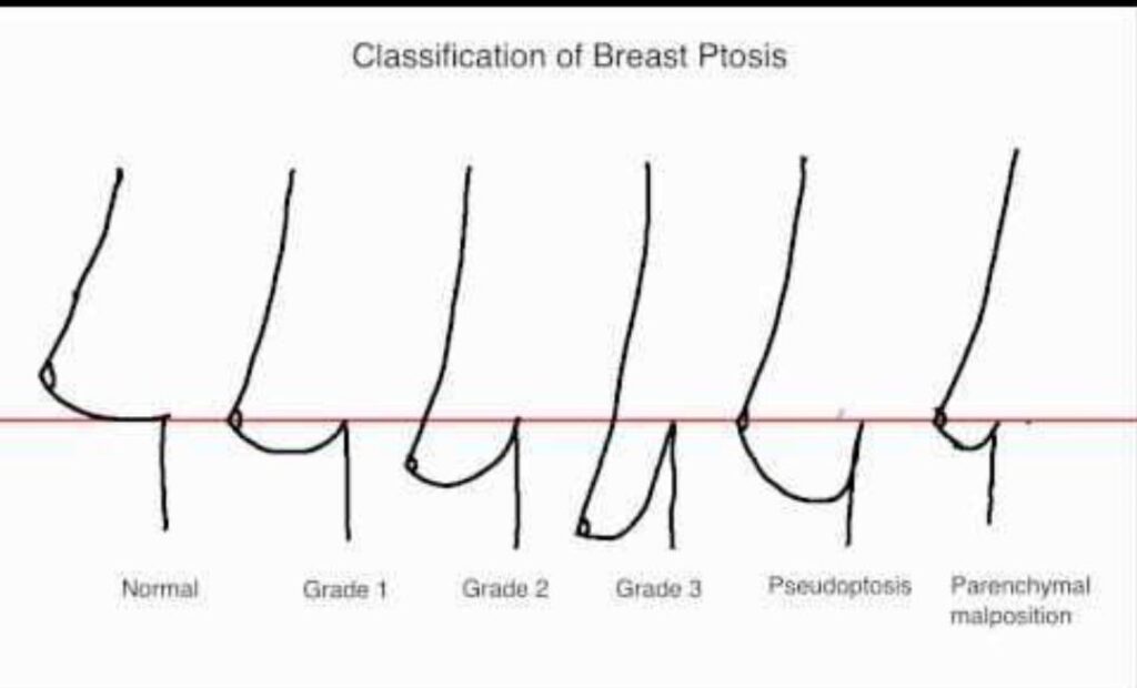 BREAST LIFT_1
