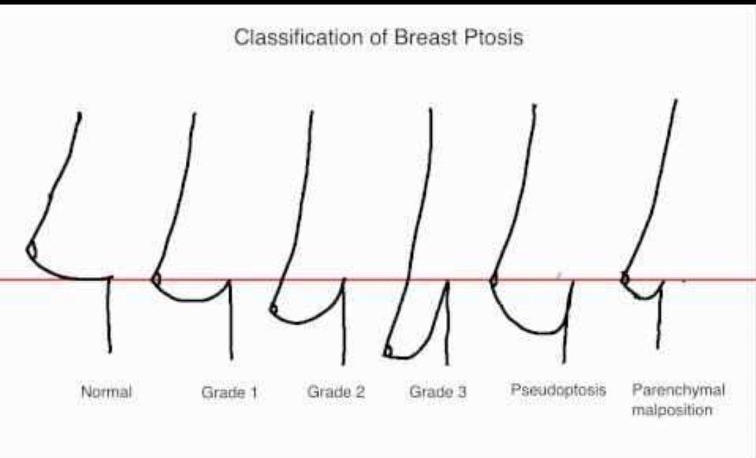 Breast Lift (Mastopexy) clinical or result imagery