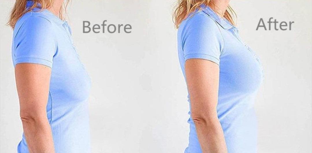 Breast Lift (Mastopexy) clinical or result imagery