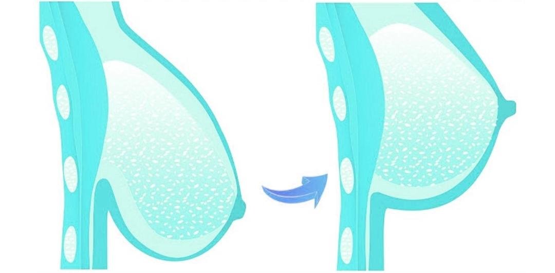 Breast Lift (Mastopexy) example from the practice media library