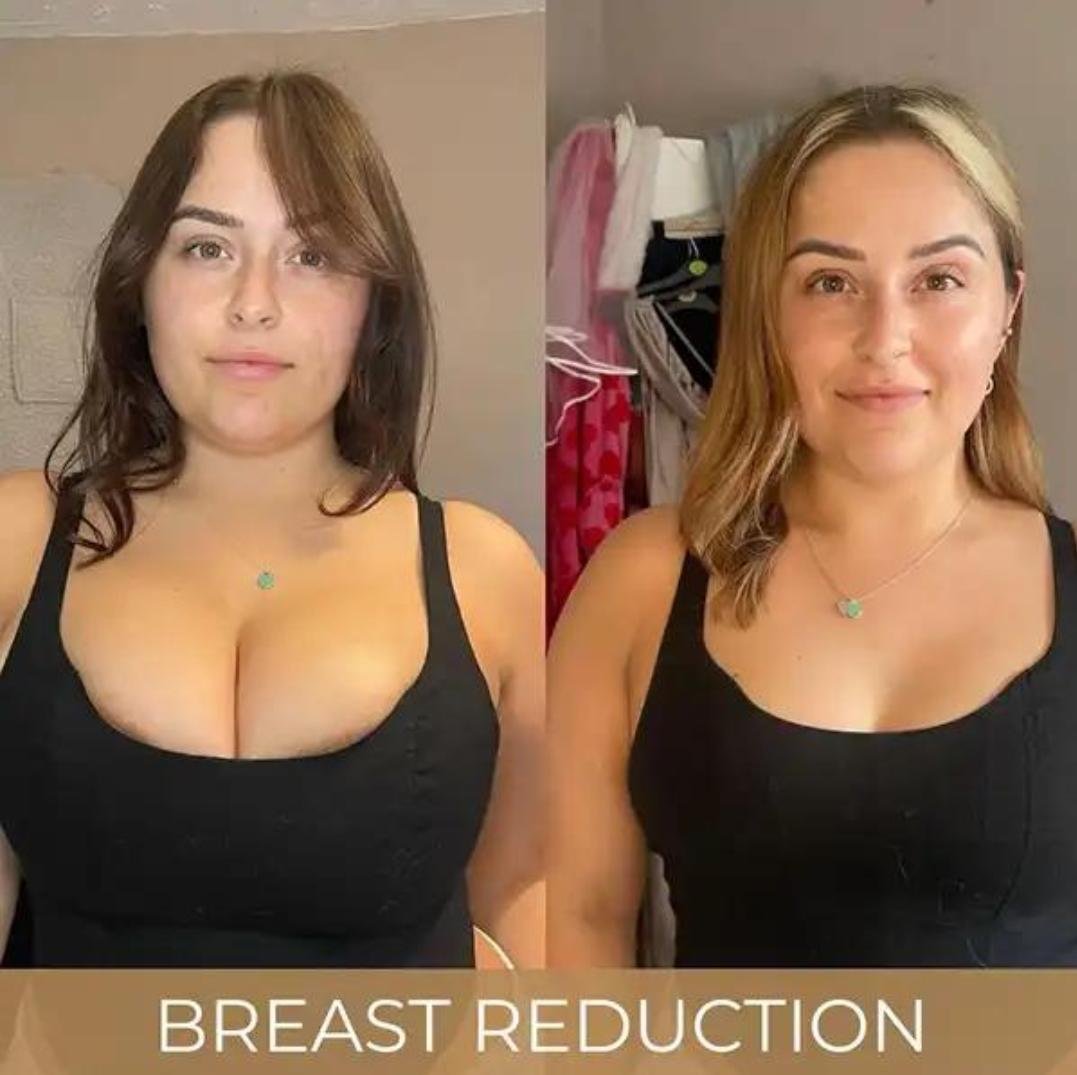 Breast Reduction clinical or result imagery