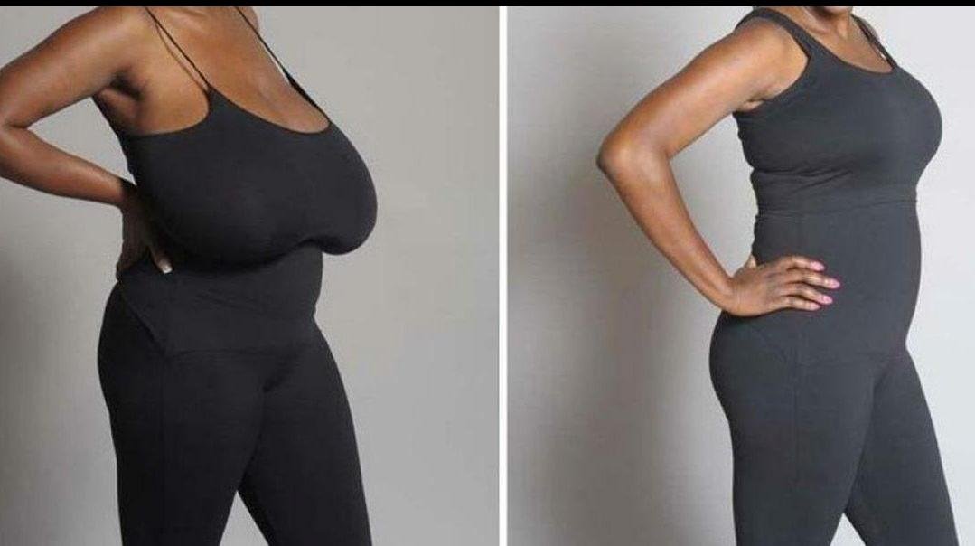 Breast Reduction example from the practice media library