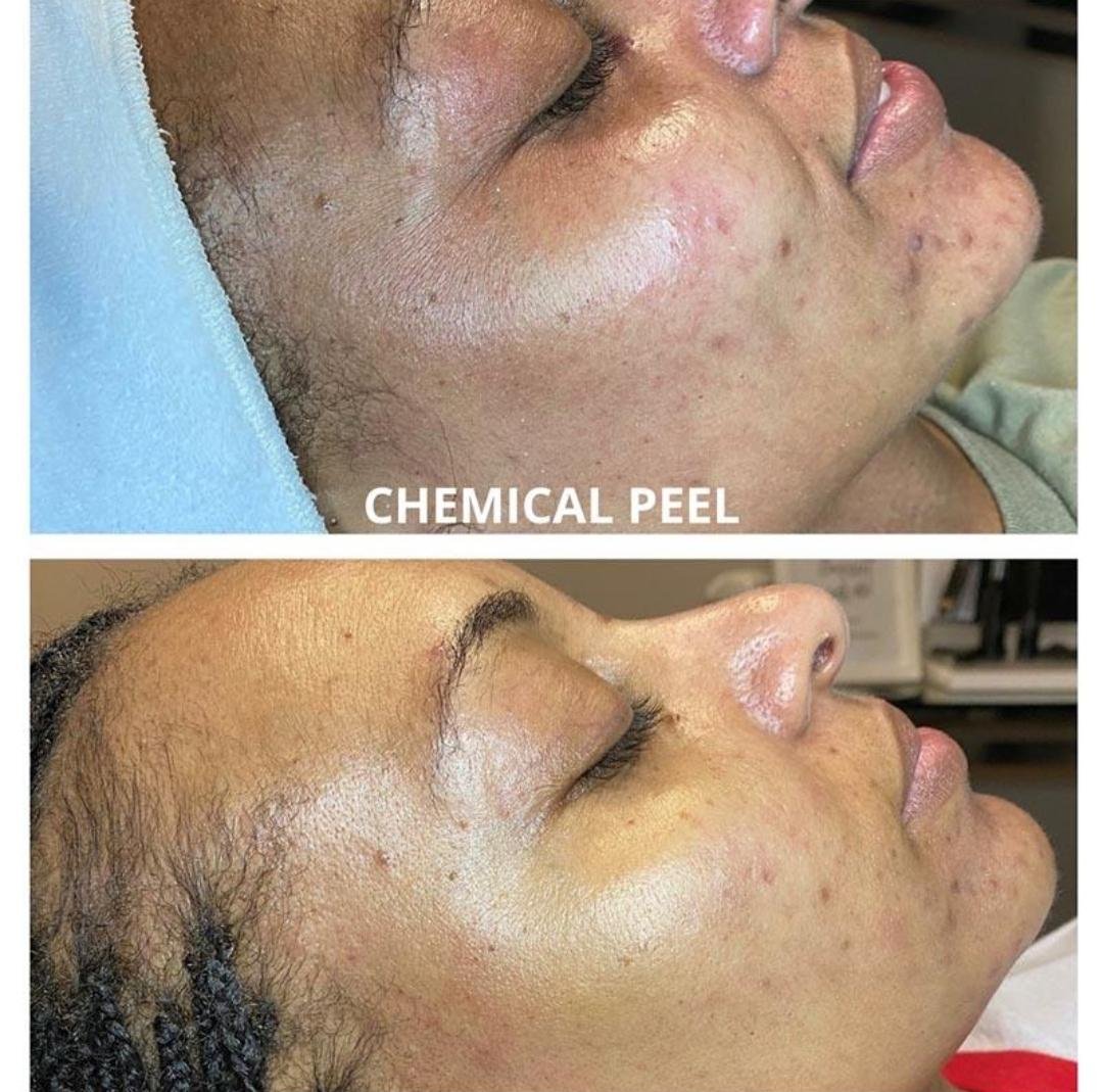 Chemical Peel example from the practice media library
