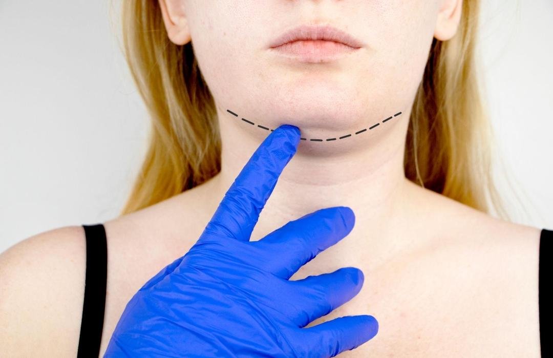 Chin Lift / Lower-Face Tightening clinical or result imagery