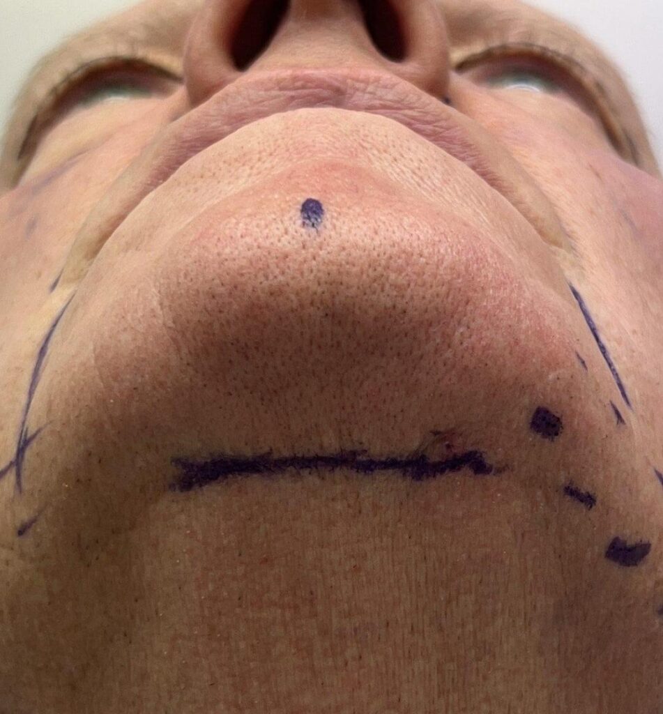 CHIN LIFT_2