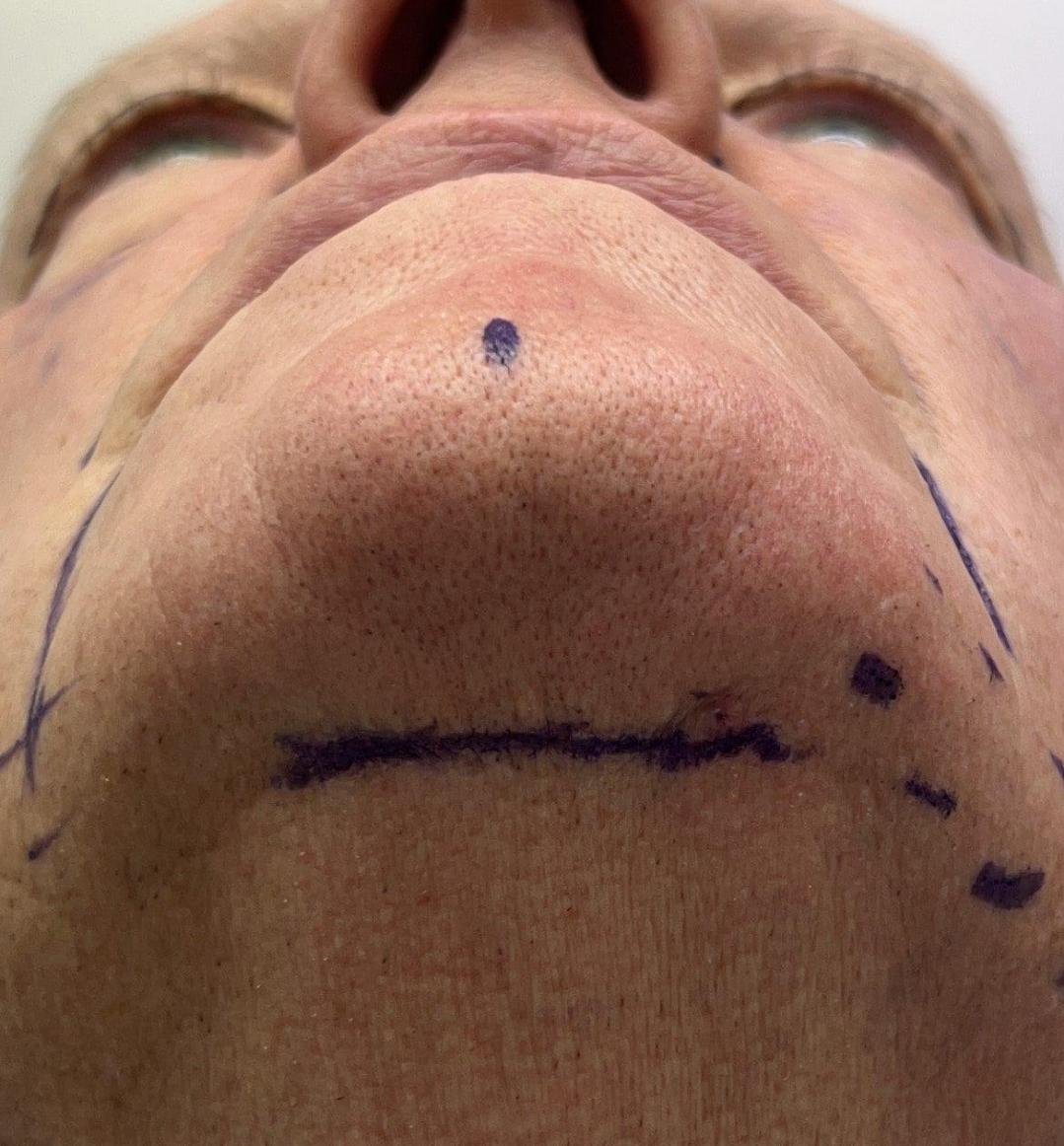 Chin Lift / Lower-Face Tightening clinical or result imagery