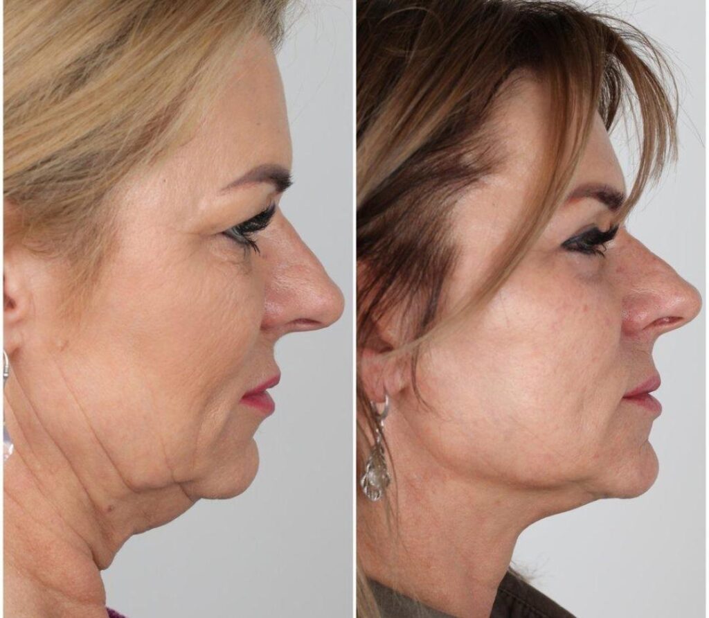 CHIN LIFT_3