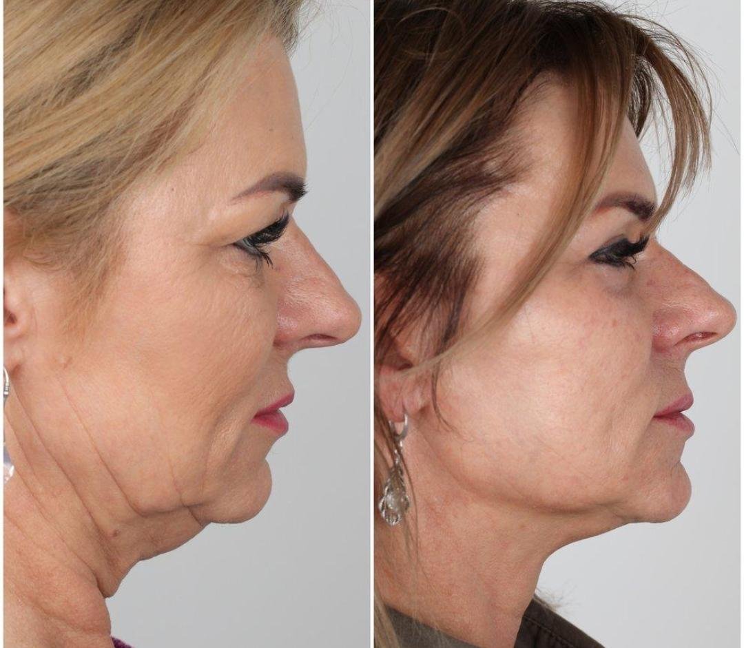 Chin Lift / Lower-Face Tightening example from the practice media library