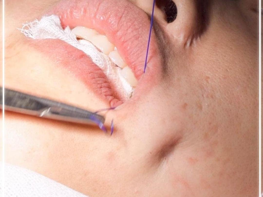 Dimpleplasty clinical or result imagery