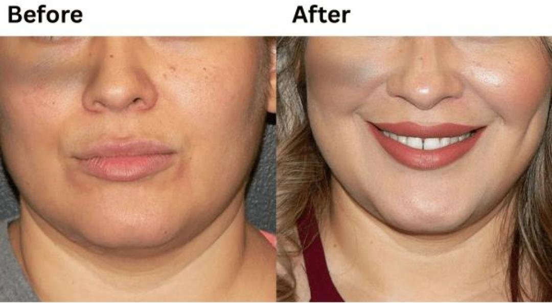 Dimpleplasty clinical or result imagery