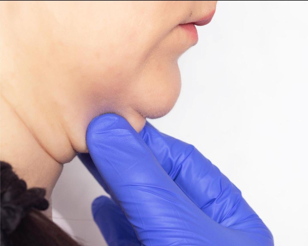 Double Chin Treatment clinical or result imagery