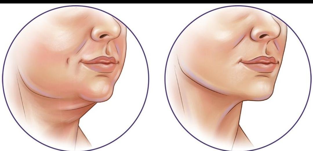Double Chin Treatment clinical or result imagery
