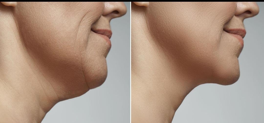 Double Chin Treatment example from the practice media library