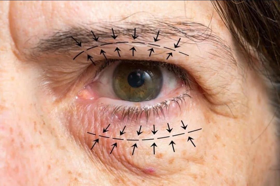 Eye Bag Surgery (Blepharoplasty) clinical or result imagery