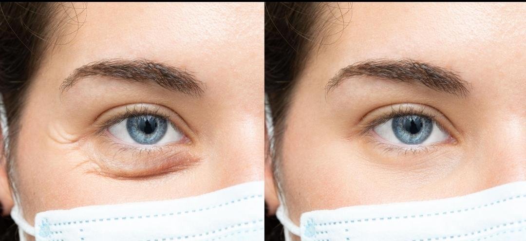 Eye Bag Surgery (Blepharoplasty) clinical or result imagery
