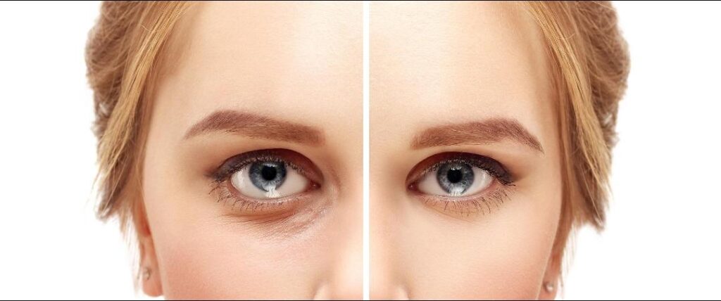 EYEBAG SURGERY_3
