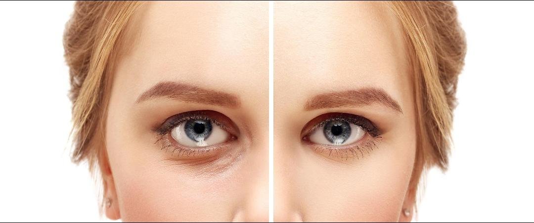 Eye Bag Surgery (Blepharoplasty) example from the practice media library